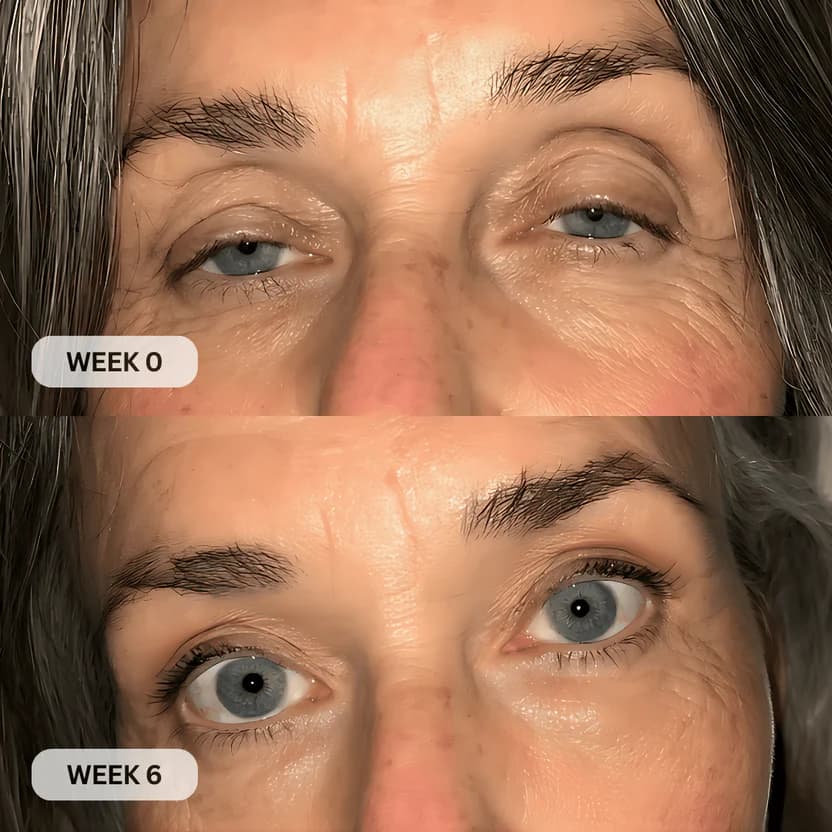 Eye area improvement